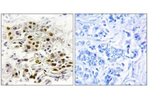 Immunohistochemistry analysis of paraffin-embedded human breast carcinoma tissue, using MAP3K6 antibody. (MAP3K6 anticorps  (Internal Region))