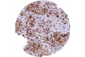 Esophagus Neuroendocrine carcinoma with strong somatostatin immunostaining of tumor cells (Recombinant Somatostatin anticorps)