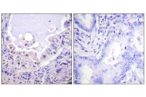 Immunohistochemistry analysis of paraffin-embedded human lung carcinoma tissue using Raf1 (epitope around residue 621) antibody.