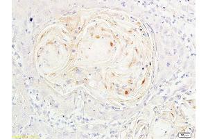 Formalin-fixed and paraffin embedded human oral squamous cell carcinoma labeled with Anti-Phospho-FoxO3a (Ser318/321) Polyclonal Antibody, Unconjugated  at 1:200 followed by conjugation to the secondary antibody and DAB staining
