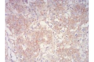 Immunohistochemical analysis of paraffin-embedded stomach cancer tissues using PYCARD mouse mAb with DAB staining.