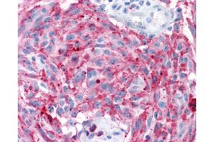 Anti-MRGD / MRGPRD antibody IHC of human Skin, Melanoma. (MRGPRD anticorps  (Extracellular Domain))