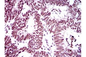 Immunohistochemical analysis of paraffin-embedded rectum cancer tissues using Ring1 mouse mAb with DAB staining.