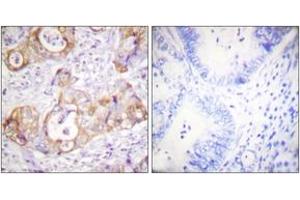 Immunohistochemistry analysis of paraffin-embedded human colon carcinoma, using Keratin 8 (Phospho-Ser432) Antibody. (KRT8 anticorps  (pSer432))