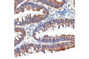 Immunohistochemistry of paraffin-embedded human colon carcinoma using P Rabbit mAb (ABIN1682842, ABIN3019312, ABIN3019313 and ABIN7101749) at dilution of 1:100 (40x lens).