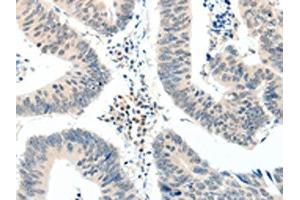The image on the left is immunohistochemistry of paraffin-embedded Human colon cancer tissue using ABIN7192880(TRAF7 Antibody) at dilution 1/20, on the right is treated with synthetic peptide. (TRAF7 anticorps)