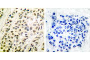 Peptide - +Immunohistochemical analysis of paraffin-embedded human breast carcinoma tissue using DP-1 antibody.