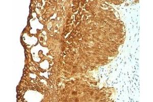 Formalin-fixed, paraffin-embedded human cervical carcinoma stained with Cytokeratin 19 antibody (KRT19/799) (Cytokeratin 19 anticorps)