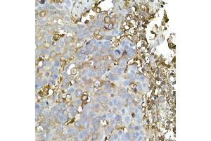 Immunohistochemistry of paraffin-embedded human esophageal cancer using C Rabbit mAb (ABIN7266058) at dilution of 1:50 (40x lens). (CAP1 anticorps)