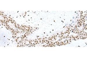 Immunohistochemistry of paraffin-embedded Human breast cancer tissue using PUM3 Polyclonal Antibody at dilution of 1:80(x200) (Pumilio 3 anticorps)