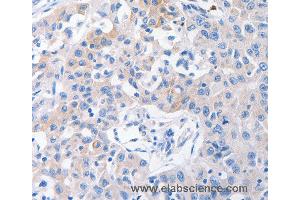 Immunohistochemistry of Human lung cancer using SLC10A1 Polyclonal Antibody at dilution of 1:31 (SLC10A1 anticorps)