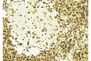 ABIN6277627 at 1/100 staining Human breast cancer tissue by IHC-P. (Plakophilin 2 anticorps  (N-Term))