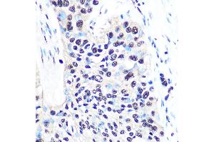 Immunohistochemistry of paraffin-embedded human esophageal cancer using NONO/p54nrb Rabbit mAb (ABIN7268947) at dilution of 1:100 (40x lens). (NONO anticorps)