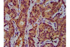 IHC image of ABIN7143840 diluted at 1:400 and staining in paraffin-embedded human liver cancer performed on a Leica BondTM system.