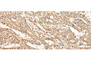 Immunohistochemistry of paraffin-embedded Human liver cancer tissue using GATD3B Polyclonal Antibody at dilution of 1:35(x200) (C21orf33 anticorps)