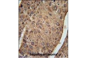 RPL27A Antibody (C-term) (ABIN654891 and ABIN2844541) immunohistochemistry analysis in formalin fixed and paraffin embedded human hepatocarcinoma followed by peroxidase conjugation of the secondary antibody and DAB staining.