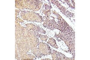 Immunohistochemical analysis of paraffin-embedded human lung adenocarcinoma tissue using ASK1 (Phospho-Ser83) Antibody (E012058). (ASK1 anticorps  (pSer83))