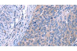 Immunohistochemistry of paraffin-embedded Human cervical cancer using ESPL1 Polyclonal Antibody at dilution of 1:40 (Separase anticorps)