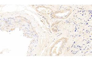Detection of CDK4 in Human Breast cancer Tissue using Polyclonal Antibody to Cyclin Dependent Kinase 4 (CDK4)