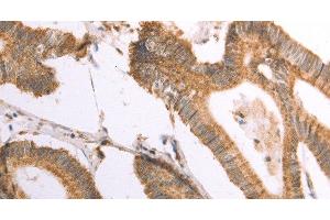 Immunohistochemistry of paraffin-embedded Human colon cancer using NAMPT Polyclonal Antibody at dilution of 1:30 (NAMPT anticorps)