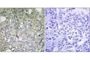 Immunohistochemistry analysis of paraffin-embedded human breast carcinoma tissue, using ADRA1D Antibody.