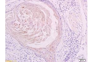 Formalin-fixed and paraffin embedded human oral squamous cell carcinoma labeled with Anti LYVE-1 Polyclonal Antibody, Unconjugated (ABIN674799) at 1:200 followed by conjugation to the secondary antibody and DAB staining (LYVE1 anticorps  (AA 231-318))