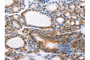 The image on the left is immunohistochemistry of paraffin-embedded Human thyroid cancer tissue using ABIN7190308(CMTM3 Antibody) at dilution 1/20, on the right is treated with synthetic peptide. (CMTM3 anticorps)