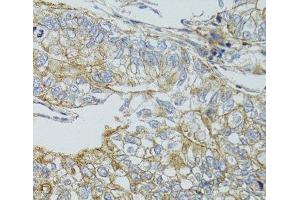 Immunohistochemistry of paraffin-embedded Human gastric cancer using CHMP4B Polyclonal Antibody at dilution of 1:100 (40x lens). (CHMP4B anticorps)