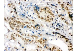 nmt55/p54nrb was detected in paraffin-embedded sections of human intestinal cancer tissues using rabbit anti- nmt55/p54nrb Antigen Affinity purified polyclonal antibody at 1 μg/mL. (NONO anticorps  (N-Term))