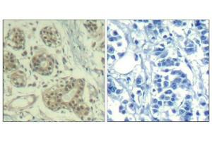 Immunohistochemical analysis of paraffin-embedded human breast carcinoma tissue using MDM2(Phospho-Ser166) Antibody(left) or the same antibody preincubated with blocking peptide(right). (MDM2 anticorps  (pSer166))