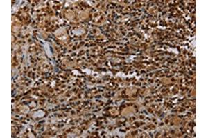 The image on the left is immunohistochemistry of paraffin-embedded Human thyroid cancer tissue using ABIN7192743(TBX5 Antibody) at dilution 1/35, on the right is treated with synthetic peptide.