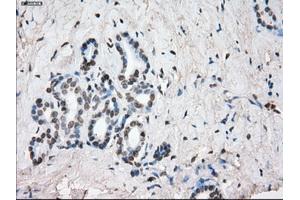 Immunohistochemical staining of paraffin-embedded Adenocarcinoma of colon tissue using anti-SLC7A8mouse monoclonal antibody.