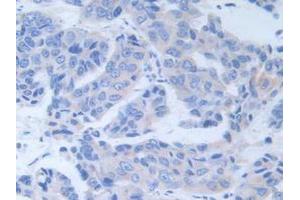IHC-P analysis of Human Breast Cancer Tissue, with DAB staining. (ALT anticorps  (AA 255-496))