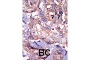 Formalin-fixed and paraffin-embedded human cancer tissue reacted with the primary antibody, which was peroxidase-conjugated to the secondary antibody, followed by AEC staining.