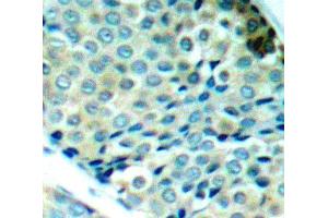 Immunohistochemistry of paraffin-embedded human breast carcinoma using Phospho-HSPB1-S78 antibody (ABIN2987689). (HSP27 anticorps  (pSer78))