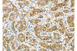 ABIN6260181 and ABIN6277800 at 1/100 staining Human liver cancer by IHC-P. (BACE1 anticorps  (C-Term))
