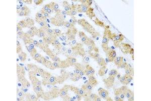 Immunohistochemistry of paraffin-embedded Human liver damage using CETN3 Polyclonal Antibody at dilution of 1:100 (40x lens).