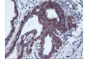 Immunohistochemical staining of paraffin-embedded Human breast tissue using anti-ALOX15 mouse monoclonal antibody. (ALOX15 anticorps)