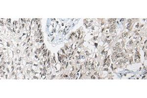 Immunohistochemistry of paraffin-embedded Human lung cancer tissue using DGKI Polyclonal Antibody at dilution of 1:80(x200) (DGKI anticorps)
