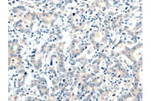 The image on the left is immunohistochemistry of paraffin-embedded Human gastric cancer tissue using ABIN7192880(TRAF7 Antibody) at dilution 1/20, on the right is treated with synthetic peptide. (TRAF7 anticorps)
