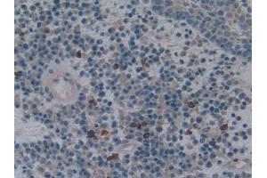 DAB staining on IHC-P; Samples: Human Skin cancer Tissue (HMOX1 anticorps  (AA 61-172))