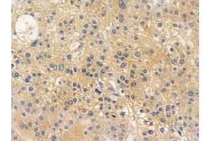 ABIN6256624 and ABIN6267265 at 1/100 staining human hepatocellular carcinoma by IHC-P.
