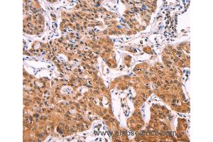 Immunohistochemistry of Human lung cancer using IL1RL1 Polyclonal Antibody at dilution of 1:70 (IL1RL1 anticorps)