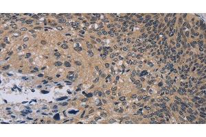 Immunohistochemistry of paraffin-embedded Human cervical cancer tissue using NOX1 Polyclonal Antibody at dilution 1:50 (NOX1 anticorps)