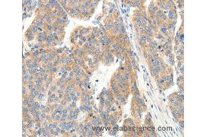 Immunohistochemistry of Human breast cancer using COL4A1 Polyclonal Antibody at dilution of 1:30 (COL4A1 anticorps)