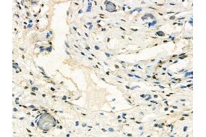 ABIN7094562 and ABIN7098611 at 1/100 staining Human ovarian cancer and adjacent normal tissues by IHC-P. (CBX1 anticorps  (Internal Region))