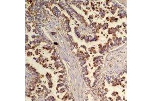 Immunohistochemical analysis of Flotillin 2 staining in human lung cancer formalin fixed paraffin embedded tissue section.