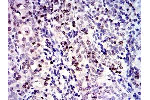 Immunohistochemical analysis of paraffin-embedded cervical cancer tissues using BIRC5 mouse mAb with DAB staining.