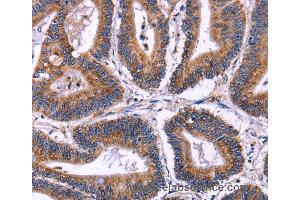 Immunohistochemistry of Human colon cancer using SIGLEC5 Polyclonal Antibody at dilution of 1:30 (SIGLEC5 anticorps)