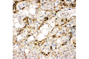 Anti-liver FABP antibody,  IHC(P) IHC(P): Human Liver Cancer Tissue